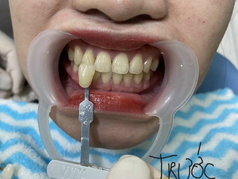 Trước Và Sau Khi Sử Dụng Dịch Vụ Ở Nha Khoa Tâm Phúc