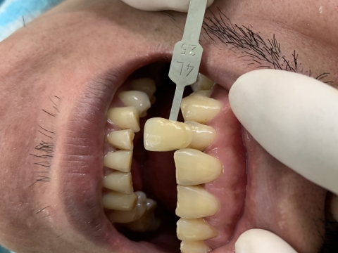 Trước Và Sau Khi Sử Dụng Dịch Vụ Ở Nha Khoa Tâm Phúc
