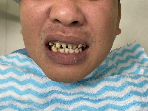 Hình Ảnh Trước Và Sau Khi Làm Răng
