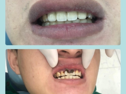 Hình Ảnh Làm Răng Tại Nha Khoa Tâm Phúc
